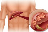 Nhiễm virus viêm gan B - nguy cơ mắc ung thư gan cao gấp 200 lần Nhiễm virus viêm gan B - nguy cơ mắc ung thư gan cao gấp 200 lần