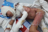 Người duy nhất còn sống trong nhà 3 người bỏng nặng đã phẫu thuật 10 lần Người duy nhất còn sống trong nhà 3 người bỏng nặng đã phẫu thuật 10 lần