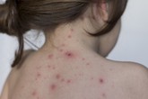 Cách phòng tránh lây nhiễm thủy đậu khi bệnh “vào mùa” Cách phòng tránh lây nhiễm thủy đậu khi bệnh “vào mùa”
