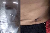 Té ngã, người phụ hồ bị 2 cây đinh đâm xuyên bụng Té ngã, người phụ hồ bị 2 cây đinh đâm xuyên bụng