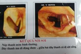 Ho ra máu, nam bệnh nhân bàng hoàng phát hiện đỉa trâu ngoe nguẩy trong cổ họng Ho ra máu, nam bệnh nhân bàng hoàng phát hiện đỉa trâu ngoe nguẩy trong cổ họng
