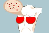 Nếu có 6 dấu hiệu này ở ngực, đừng coi nhẹ nên đi khám ngay trước khi muộn Nếu có 6 dấu hiệu này ở ngực, đừng coi nhẹ nên đi khám ngay trước khi muộn