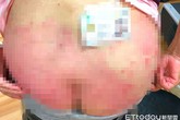 Người phụ nữ mắc bệnh vảy nến nghe lời khuyên tắm tinh dầu dưỡng da, sau 3 tháng hậu quả khôn lường Người phụ nữ mắc bệnh vảy nến nghe lời khuyên tắm tinh dầu dưỡng da, sau 3 tháng hậu quả khôn lường