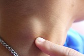 Người trên 30 tuổi nổi hạch ở cổ có nguy hiểm không? Người trên 30 tuổi nổi hạch ở cổ có nguy hiểm không?