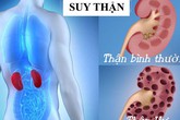 Những "sát thủ" tàn phá thận người Việt biết nhưng vẫn mắc phải Những "sát thủ" tàn phá thận người Việt biết nhưng vẫn mắc phải