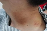 Bị đột quỵ cấp tính sau khi đi massage thư giãn, chuyên gia cảnh báo 6 dấu hiệu nguy hiểm Bị đột quỵ cấp tính sau khi đi massage thư giãn, chuyên gia cảnh báo 6 dấu hiệu nguy hiểm