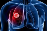 5 giải pháp đơn giản nhất để ngăn ngừa ung thư phổi: Mỗi người đều nên áp dụng sớm 5 giải pháp đơn giản nhất để ngăn ngừa ung thư phổi: Mỗi người đều nên áp dụng sớm