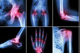 Chuyên gia y học cổ truyền lý giải hiệu quả kết hợp cao ngựa bạch và chiết xuất nhũ hương giúp hỗ trợ điều trị viêm khớp Chuyên gia y học cổ truyền lý giải hiệu quả kết hợp cao ngựa bạch và chiết xuất nhũ hương giúp hỗ trợ điều trị viêm khớp