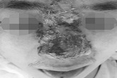 Tiêm filler nâng mũi suýt mù mắt Tiêm filler nâng mũi suýt mù mắt