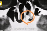 Sụt sịt 3 tháng liền, chàng trai đi khám thì phát hiện ra chiếc răng... 20 năm tuổi trong lỗ mũi Sụt sịt 3 tháng liền, chàng trai đi khám thì phát hiện ra chiếc răng... 20 năm tuổi trong lỗ mũi