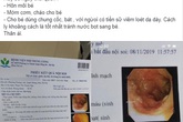 Mớm cơm cho cháu ăn, bà vô tình khiến cháu bị viêm toàn bộ niêm mạc dạ dày Mớm cơm cho cháu ăn, bà vô tình khiến cháu bị viêm toàn bộ niêm mạc dạ dày
