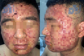 Bác sĩ giật mình khi bệnh nhân tháo khẩu trang, chi chít mụn như 'tổ ong' vì dùng thuốc lạ Bác sĩ giật mình khi bệnh nhân tháo khẩu trang, chi chít mụn như 'tổ ong' vì dùng thuốc lạ