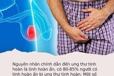 Vợ nhắc chồng: Tự làm điều này trước gương 1 lần/ngày để phát hiện sớm mình có mắc ung thư tinh hoàn hay không Vợ nhắc chồng: Tự làm điều này trước gương 1 lần/ngày để phát hiện sớm mình có mắc ung thư tinh hoàn hay không