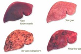 Giám đốc BV K hướng dẫn cách phòng bệnh ung thư có tỷ lệ mắc mới nhiều nhất tại Việt Nam Giám đốc BV K hướng dẫn cách phòng bệnh ung thư có tỷ lệ mắc mới nhiều nhất tại Việt Nam