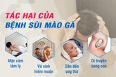 Tìm hiểu về bệnh sùi mào gà Tìm hiểu về bệnh sùi mào gà