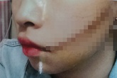 Trên đường đi làm, nữ công nhân bị rạch mặt khâu 25 mũi Trên đường đi làm, nữ công nhân bị rạch mặt khâu 25 mũi