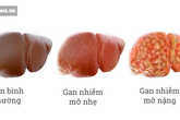 Người làm 3 việc này trước khi ngủ sẽ khiến tình trạng gan nhiễm mỡ trở nên trầm trọng hơn Người làm 3 việc này trước khi ngủ sẽ khiến tình trạng gan nhiễm mỡ trở nên trầm trọng hơn
