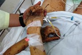 Truy tìm thủ phạm tạt axit vào đôi bạn Việt kiều về quê ăn Tết Truy tìm thủ phạm tạt axit vào đôi bạn Việt kiều về quê ăn Tết