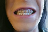 Mục nát hết răng do uống nước tăng lực, chuyên gia cảnh tỉnh về thức uống gây hại sức khỏe Mục nát hết răng do uống nước tăng lực, chuyên gia cảnh tỉnh về thức uống gây hại sức khỏe