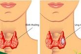 Nuốt nước bọt mà có dấu hiệu này, có khả năng bị ung thư tuyến giáp Nuốt nước bọt mà có dấu hiệu này, có khả năng bị ung thư tuyến giáp