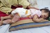 Ngã vào nồi canh, bé gái 16 tháng tuổi bị bỏng nặng, chỉ có thể nằm sấp và khóc Ngã vào nồi canh, bé gái 16 tháng tuổi bị bỏng nặng, chỉ có thể nằm sấp và khóc