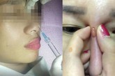 Từ vụ cô gái bị mù mắt sau khi nâng mũi, chuyên gia chỉ cách làm đẹp an toàn Từ vụ cô gái bị mù mắt sau khi nâng mũi, chuyên gia chỉ cách làm đẹp an toàn