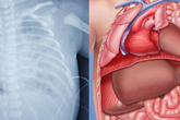 Phẫu thuật thoát vị cơ hoành bẩm sinh cho trẻ 2 ngày tuổi Phẫu thuật thoát vị cơ hoành bẩm sinh cho trẻ 2 ngày tuổi