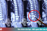 Không thể di chuyển do căn bệnh khó phát hiện trong ống sống Không thể di chuyển do căn bệnh khó phát hiện trong ống sống