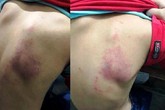 Cô chủ nhiệm bị phạt 5 triệu đồng vì đánh học sinh lớp 2 tím lưng Cô chủ nhiệm bị phạt 5 triệu đồng vì đánh học sinh lớp 2 tím lưng