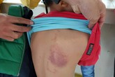 Đình chỉ cô giáo đánh bầm tím lưng học sinh lớp 2 Đình chỉ cô giáo đánh bầm tím lưng học sinh lớp 2