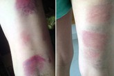 Làm rõ vụ cô giáo chủ nhiệm đánh 22 học sinh bầm tím Làm rõ vụ cô giáo chủ nhiệm đánh 22 học sinh bầm tím