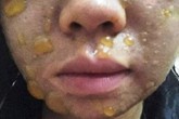 "Peel da" tại nhà, cô gái sắp cưới bị bỏng a-xít, mặt chi chít mụn nước "Peel da" tại nhà, cô gái sắp cưới bị bỏng a-xít, mặt chi chít mụn nước