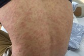 8 dấu hiệu cảnh báo cơ thể nhiễm ký sinh trùng 8 dấu hiệu cảnh báo cơ thể nhiễm ký sinh trùng