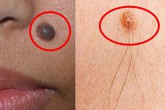 Nốt ruồi cứ có lông sẽ là ung thư? Nốt ruồi cứ có lông sẽ là ung thư?