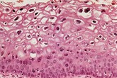 Vắc-xin HPV giúp giảm đáng kể nguy cơ ung thư cổ tử cung Vắc-xin HPV giúp giảm đáng kể nguy cơ ung thư cổ tử cung