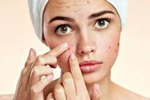 Tuổi 50 mọc nhiều trứng cá, vì sao? Tuổi 50 mọc nhiều trứng cá, vì sao?