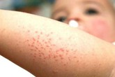 Dùng thuốc nào trị rôm sảy? Dùng thuốc nào trị rôm sảy?