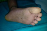 Mặt, môi bé 3 tuổi đột nhiên tím tái, sốc phản vệ sau 5 phút bị kiến đốt Mặt, môi bé 3 tuổi đột nhiên tím tái, sốc phản vệ sau 5 phút bị kiến đốt
