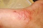 Bệnh nhiễm giun lươn có thể biến chứng nặng Bệnh nhiễm giun lươn có thể biến chứng nặng