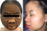 Thay đổi bất ngờ trên gương mặt cô gái trẻ sùi như vỏ mít sau khi dùng thuốc làm trắng Thay đổi bất ngờ trên gương mặt cô gái trẻ sùi như vỏ mít sau khi dùng thuốc làm trắng