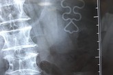 Vòng tránh thai đi "lạc" lên vị trí không ai ngờ của người phụ nữ 65 tuổi Vòng tránh thai đi "lạc" lên vị trí không ai ngờ của người phụ nữ 65 tuổi