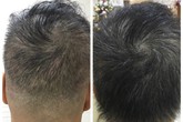 Phương pháp “thần kỳ” giúp tóc mọc dày gấp đôi tại bệnh viện Quốc tế DNA Phương pháp “thần kỳ” giúp tóc mọc dày gấp đôi tại bệnh viện Quốc tế DNA