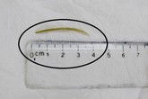 Ăn lẩu tại nhà, một phụ nữ bị xương cá đâm thủng ruột non Ăn lẩu tại nhà, một phụ nữ bị xương cá đâm thủng ruột non