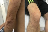 Bỗng nhiên nổi dày đặc nốt trên da, sụt cân không phanh, phát hiện u phát ban Bỗng nhiên nổi dày đặc nốt trên da, sụt cân không phanh, phát hiện u phát ban