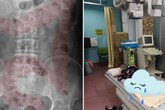 Bé gái 11 tuổi nhập viện cấp cứu vì đau dạ dày, bác sĩ chỉ đích danh thủ phạm là 1 sở thích tai hại của rất nhiều bé Bé gái 11 tuổi nhập viện cấp cứu vì đau dạ dày, bác sĩ chỉ đích danh thủ phạm là 1 sở thích tai hại của rất nhiều bé