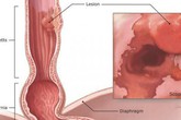 Bác sĩ khuyến cáo 3 yếu tố phổ biến có thể gây ung thư thực quản, ai cũng nên tránh Bác sĩ khuyến cáo 3 yếu tố phổ biến có thể gây ung thư thực quản, ai cũng nên tránh