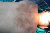 Cho thầy lang nắn bóp liên tục 6 tiếng, người phụ nữ mất hết khả năng vận động, cảm giác Cho thầy lang nắn bóp liên tục 6 tiếng, người phụ nữ mất hết khả năng vận động, cảm giác