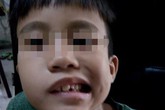 Ngủ dậy, bé trai 8 tuổi hốt hoảng vì bị lệch mặt, méo miệng, mắt không thể nhắm kín Ngủ dậy, bé trai 8 tuổi hốt hoảng vì bị lệch mặt, méo miệng, mắt không thể nhắm kín