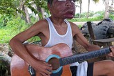 Người đàn ông Philippines có gương mặt sưng to gấp ba lần vì bệnh lạ Người đàn ông Philippines có gương mặt sưng to gấp ba lần vì bệnh lạ