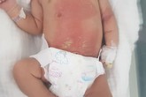 Con 2 tuần tuổi chướng bụng, mẹ chữa theo cách này khiến con bỏng nặng Con 2 tuần tuổi chướng bụng, mẹ chữa theo cách này khiến con bỏng nặng